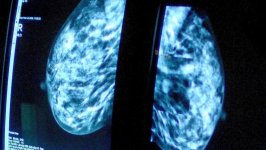 HSE approval of breast cancer drug a 'significant milestone'